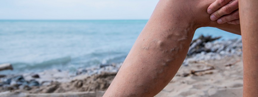 Visszereid vannak? Erre figyelj nyáron