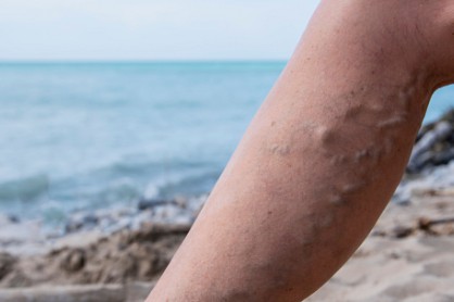 Visszereid vannak? Erre figyelj nyáron