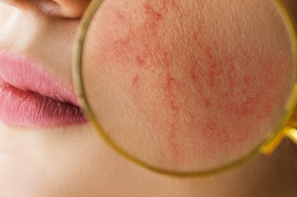Minden, amit az arcbőr kipirosodásáról tudni kell